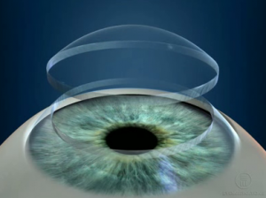 keratoconus corneal transplant