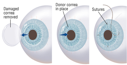 keratoconus corneal transplant