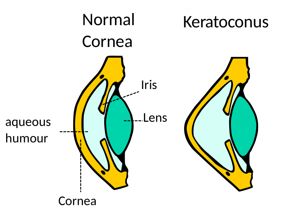 2000px-Keratoconus.svg - NKCF.org