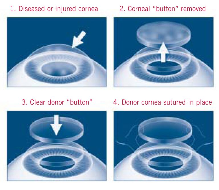 Corneal Transplant Surgery - NKCF.org