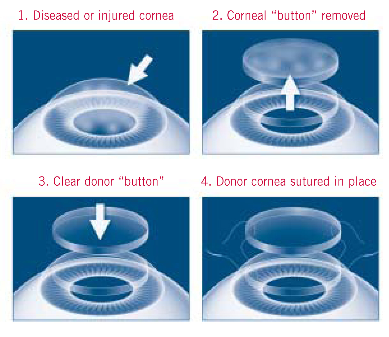 Corneal Transplant Surgery