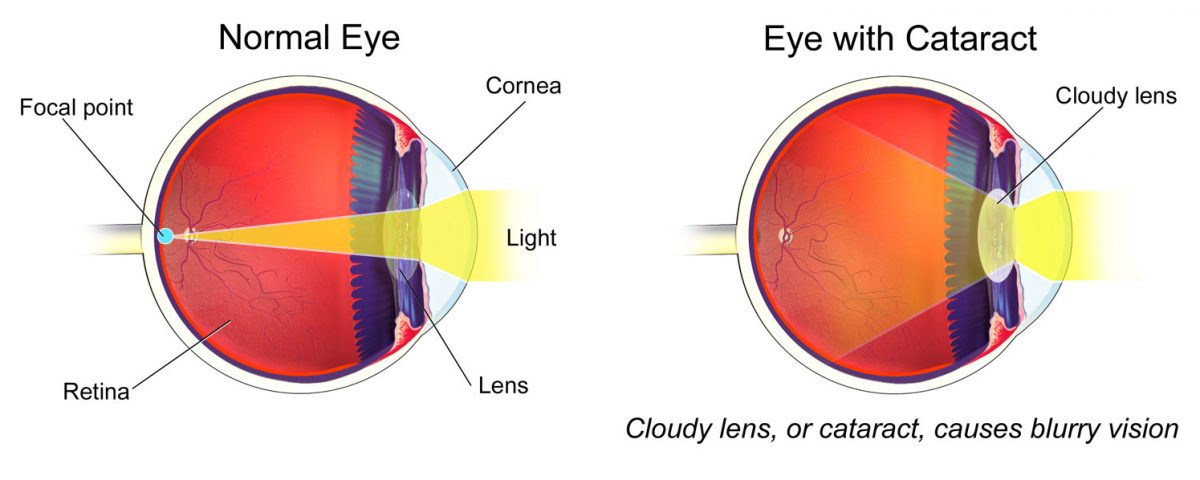 Cataract Surgery & Keratoconus - NKCF.org