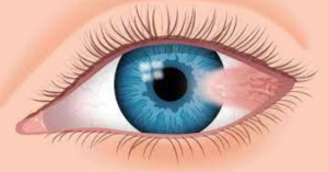 pterygium